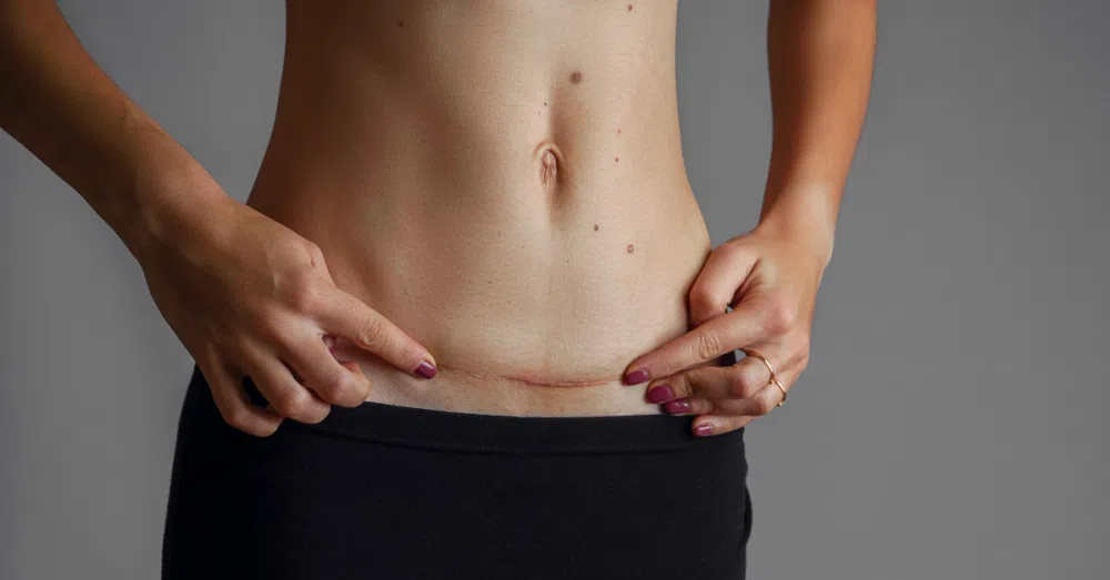 Tummy Tuck Recovery Week-by-Week Timeline & Healing