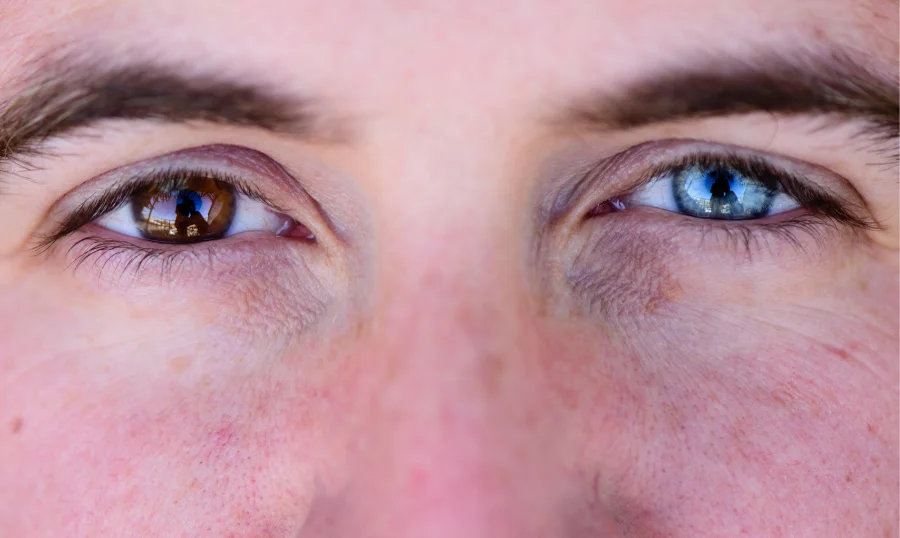 types of heterochromia