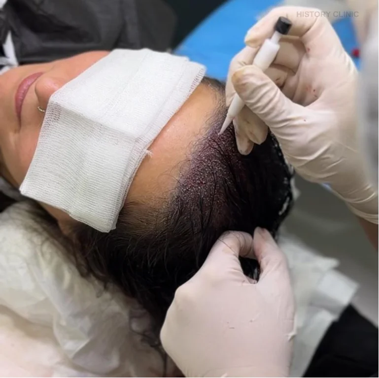 Haartransplantation ohne Rasur Ablauf, Kosten & Türkei 3 unshaven hair transplant 1