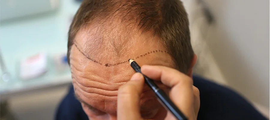 unshaven hair transplant 2