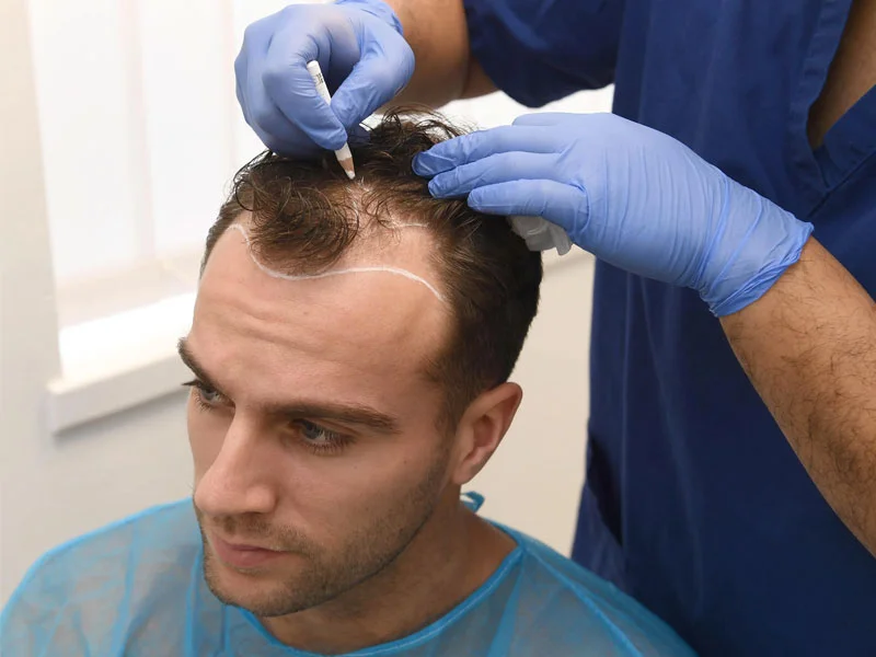 Haartransplantation ohne Rasur Ablauf, Kosten & Türkei 2 unshaven hair transplant