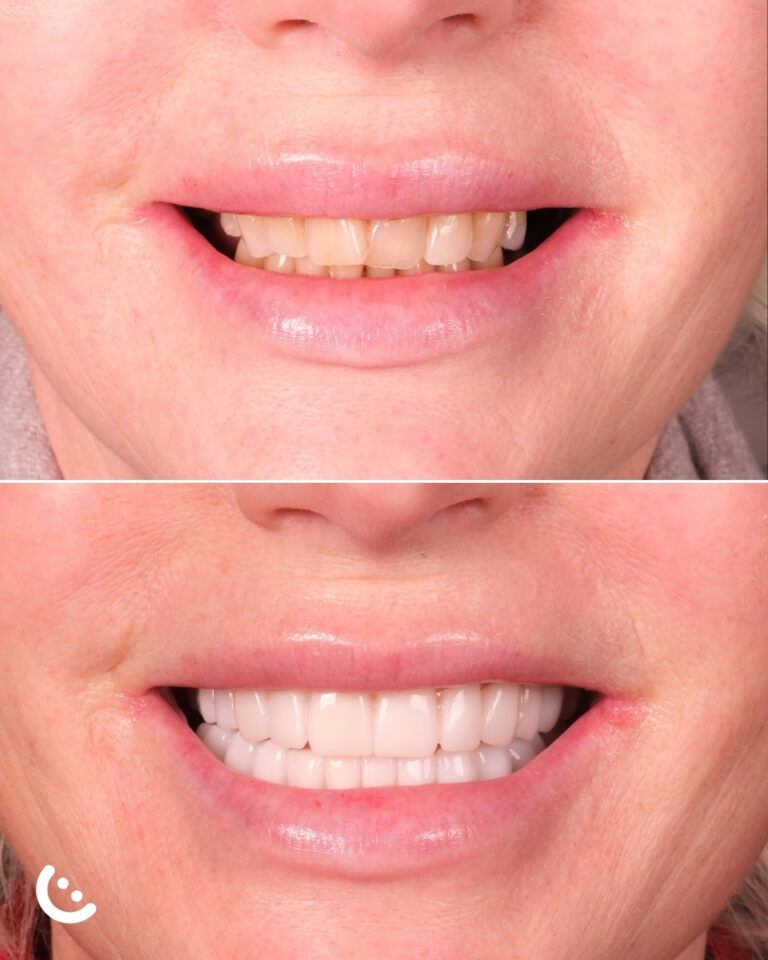 veneer in turkey before and after