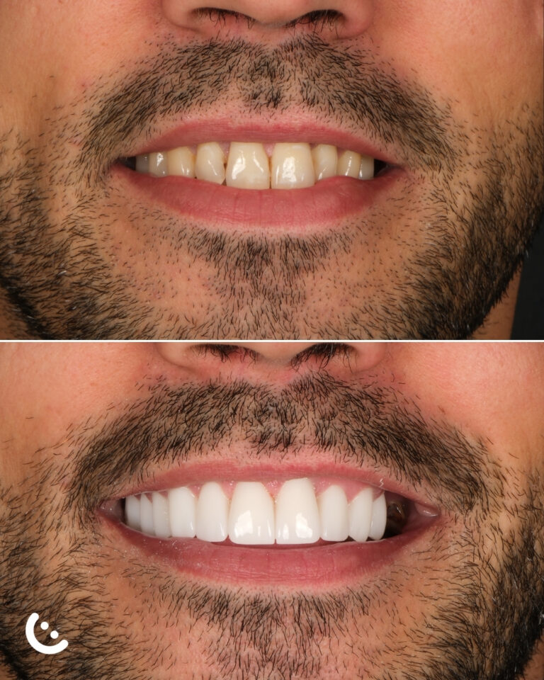 veneers in turkey before after
