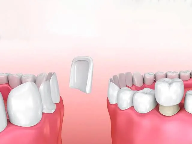 Veneers vs Crowns: Price, Durability, Differences & Pros-Cons 2 veneers vs crowns