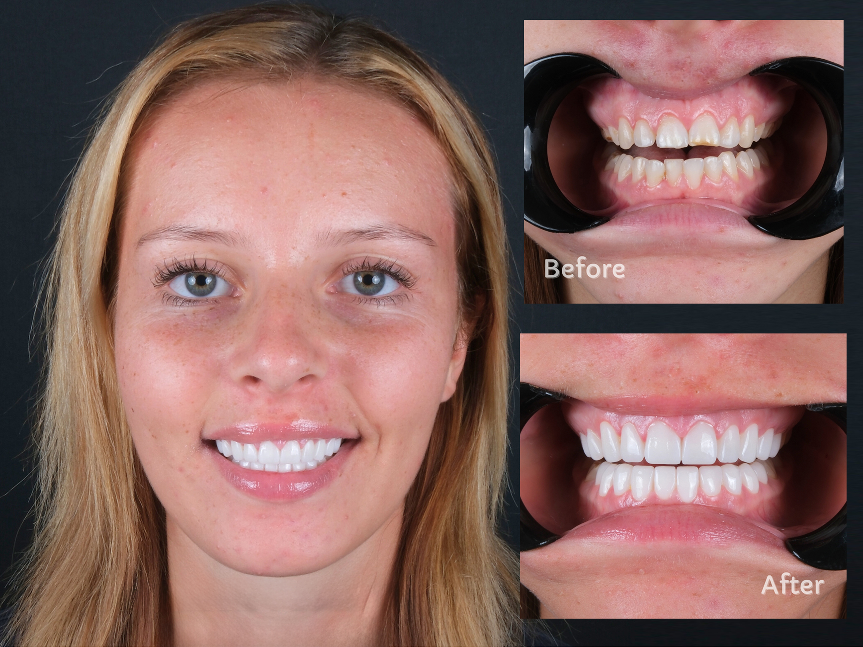 veneers