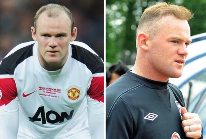 Wayne Rooney Haartransplantatie proces