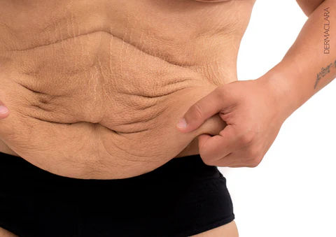 weight loss stretch marks