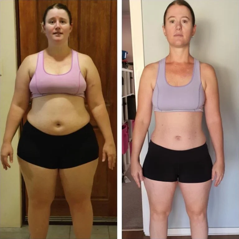 Kilo Verme Ameliyatı Fiyatı ve Başarı Oranı 3 weight loss surgery before after