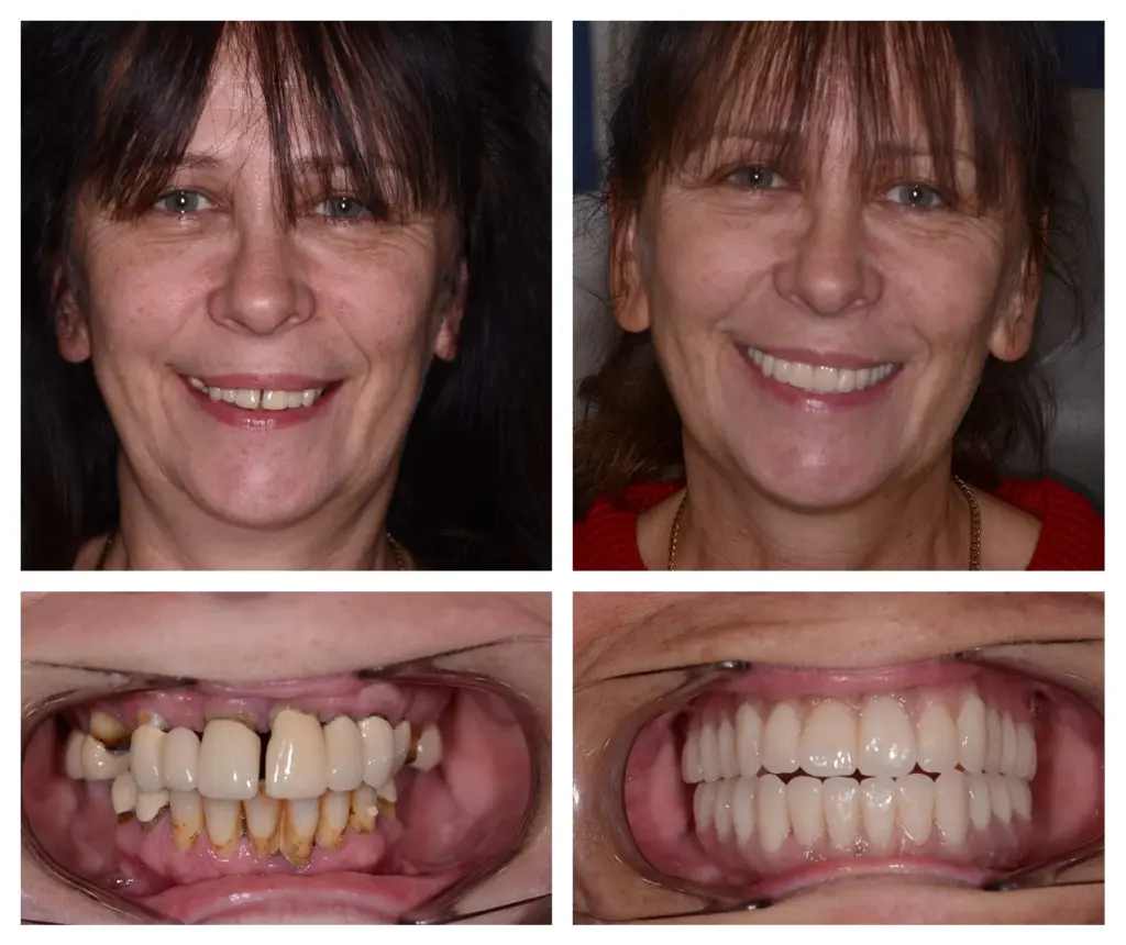what are Zygomatic implants
