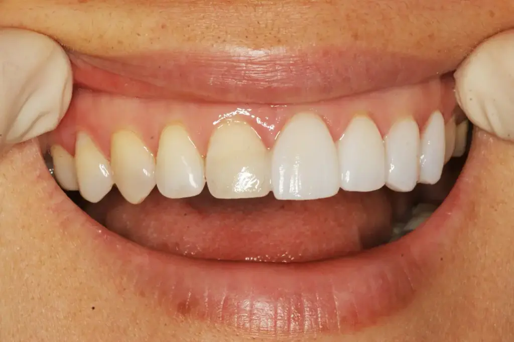 Was sind No-Prep-Veneers? Ablauf, Kosten und Komplettpakete in der Türkei 1 what are no prep veneers