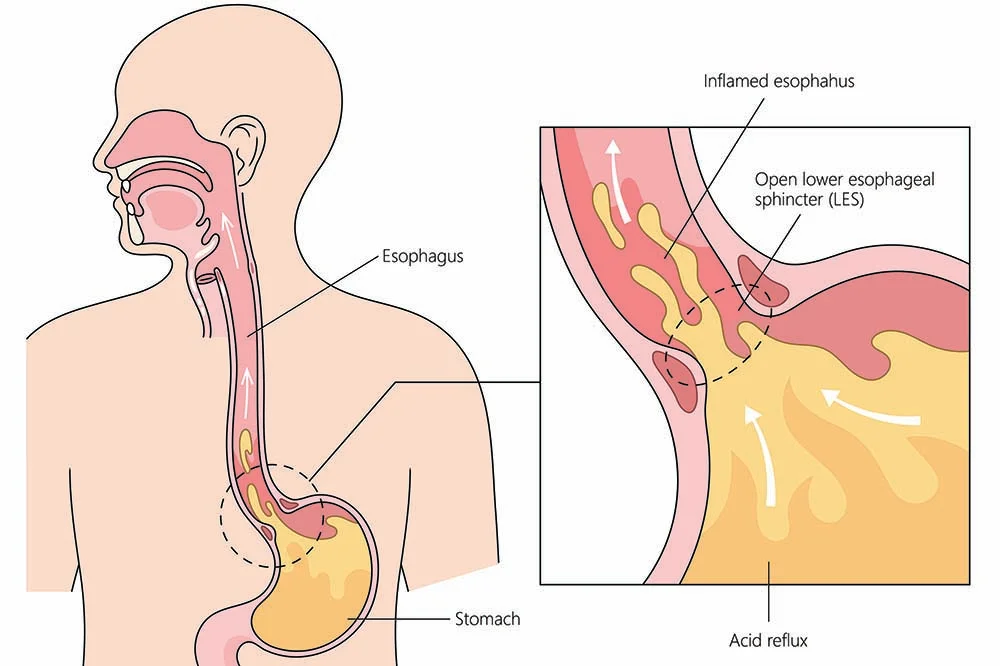 what causes acid reflux after gastric sleeve