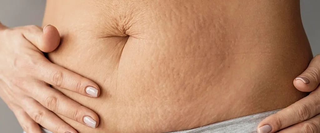 Fibrosis After Liposuction: Causes, Symptoms, Treatment 3 what causes fibrosis after liposuction
