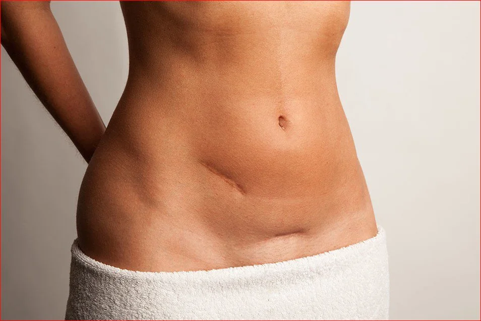 what causes seroma after liposuction