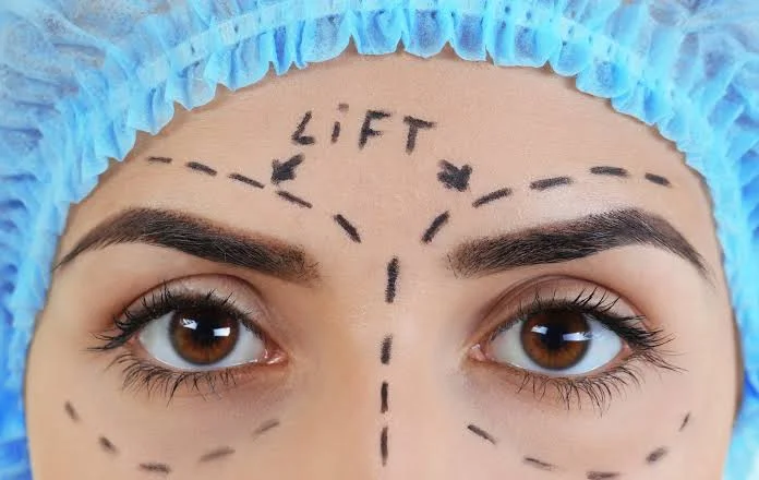 Endoscopic brow lift