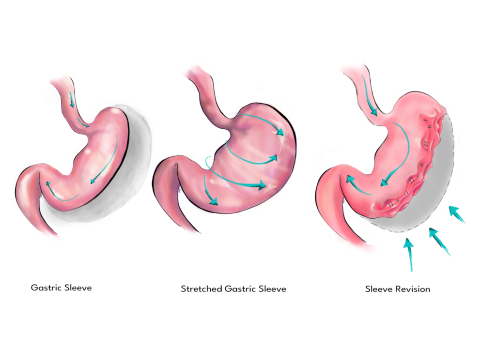 What Is Gastric Sleeve Revision Surgery? Why Is It Performed? 2 what is Gastric Sleeve Revision Surgery
