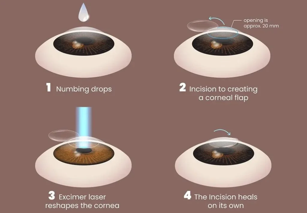 SMILE eye surgery