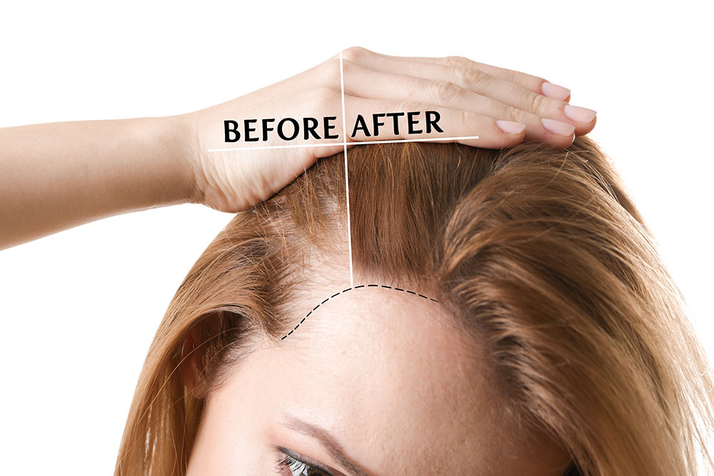 what is a hair transplant and how does it work