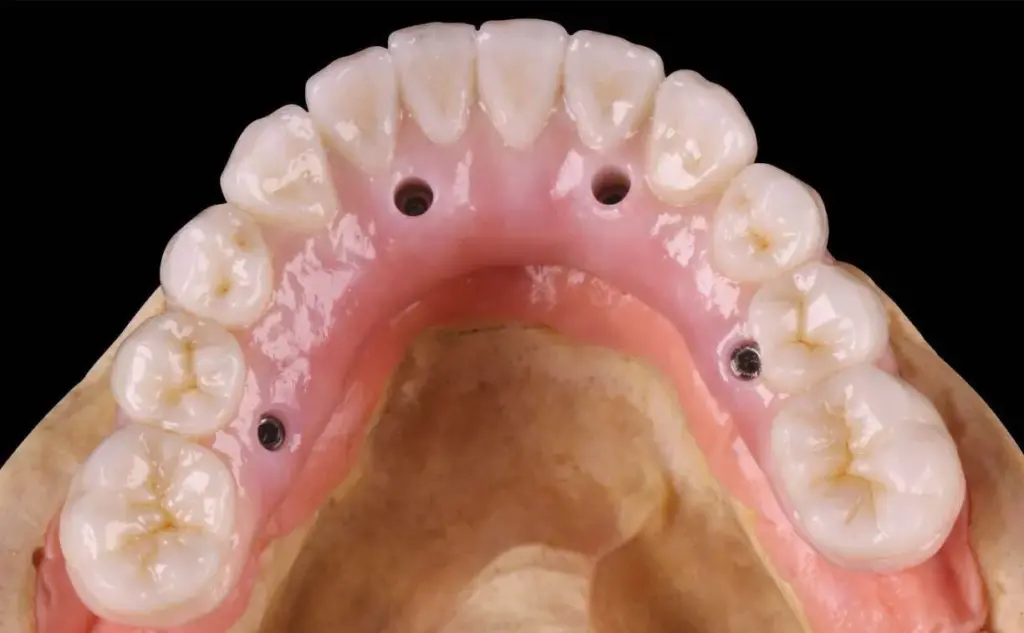 all-on-4 dental implant