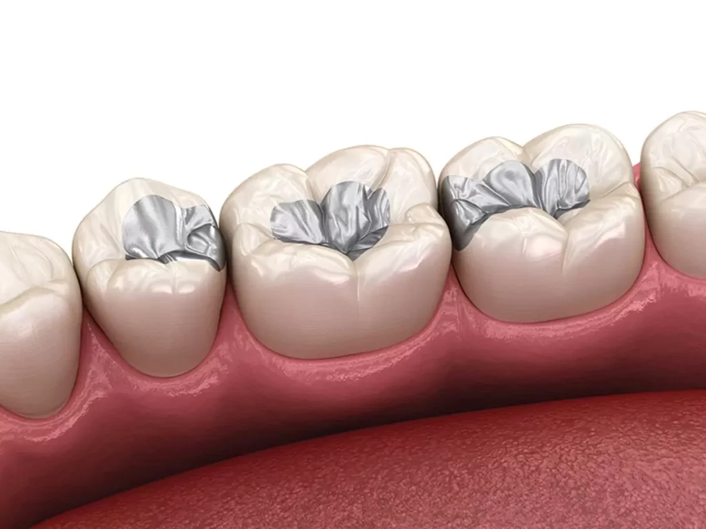 what is amalgam filling