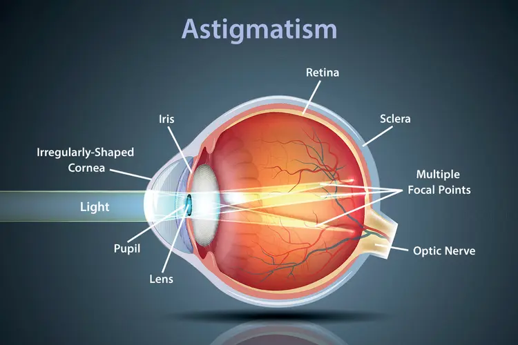 what is astigmatism