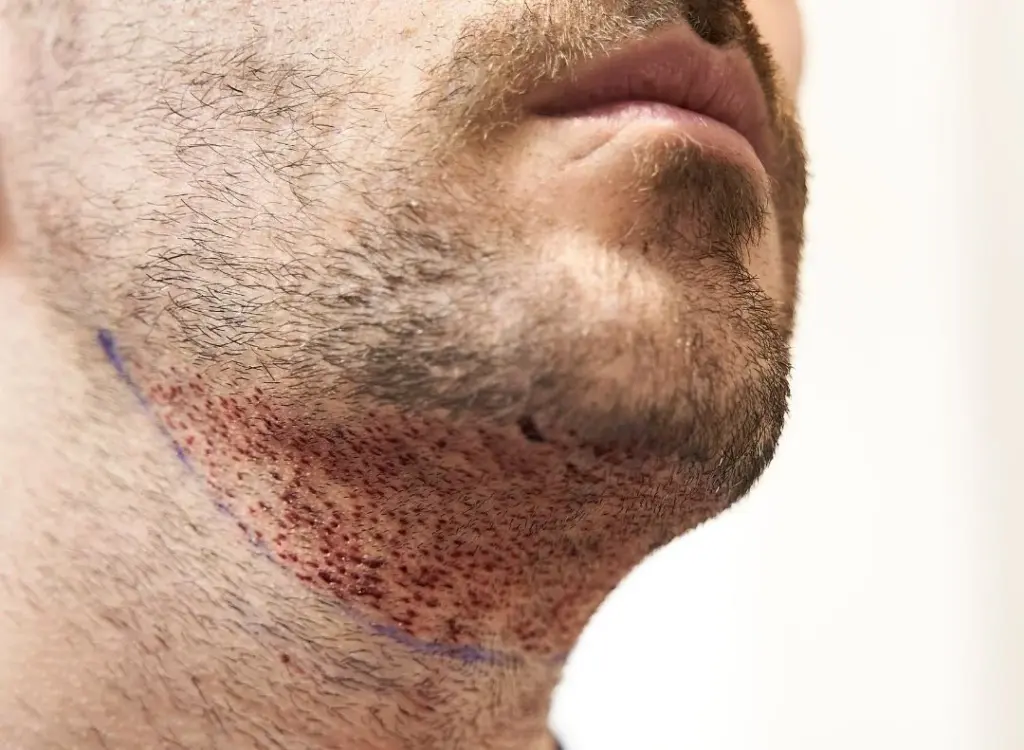what is beard to scalp hair transplant
