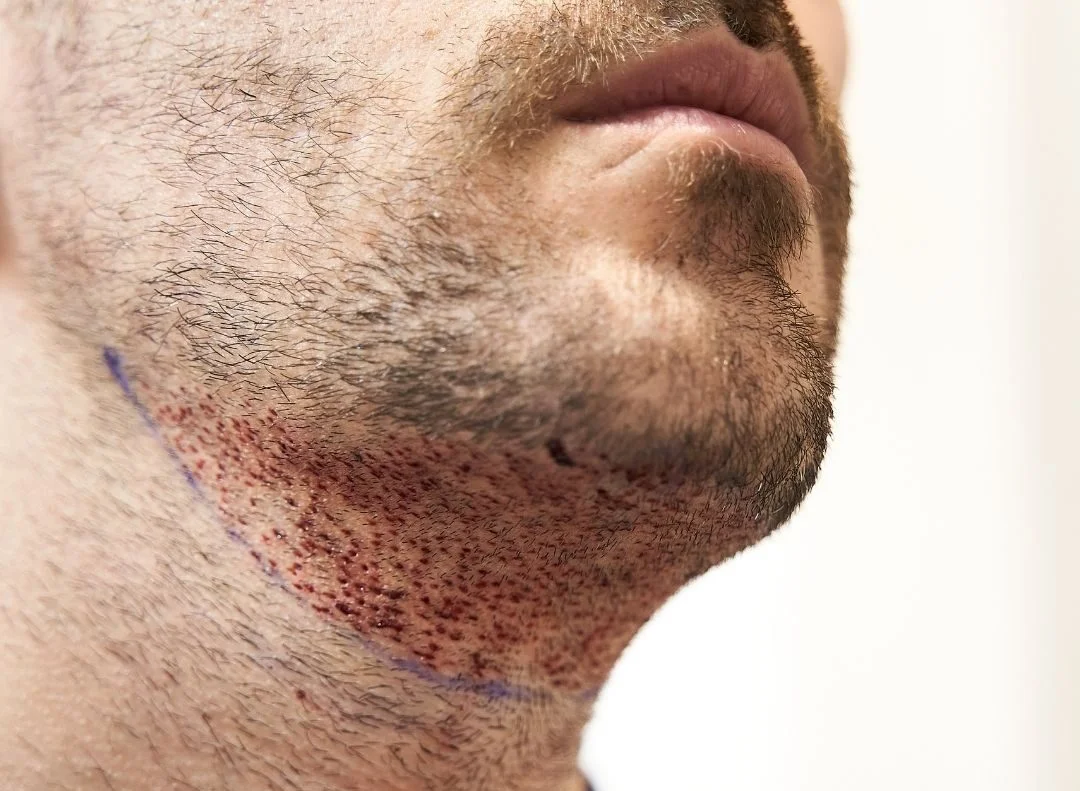 Haartransplantation von Bart zu Kopfhaut: Ablauf, Kosten & Türkei