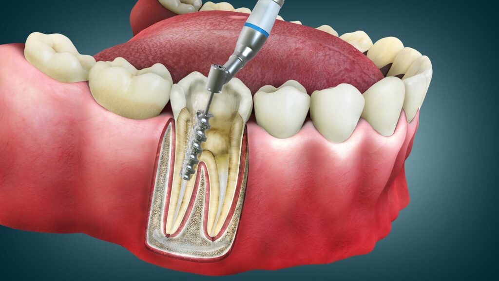 what is endodontic treatment