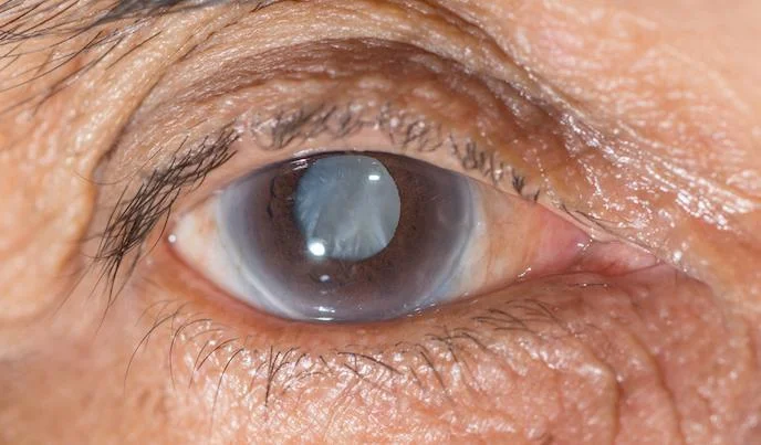 What is Glaucoma? Symptoms, Inherited Risks & Treatment Options