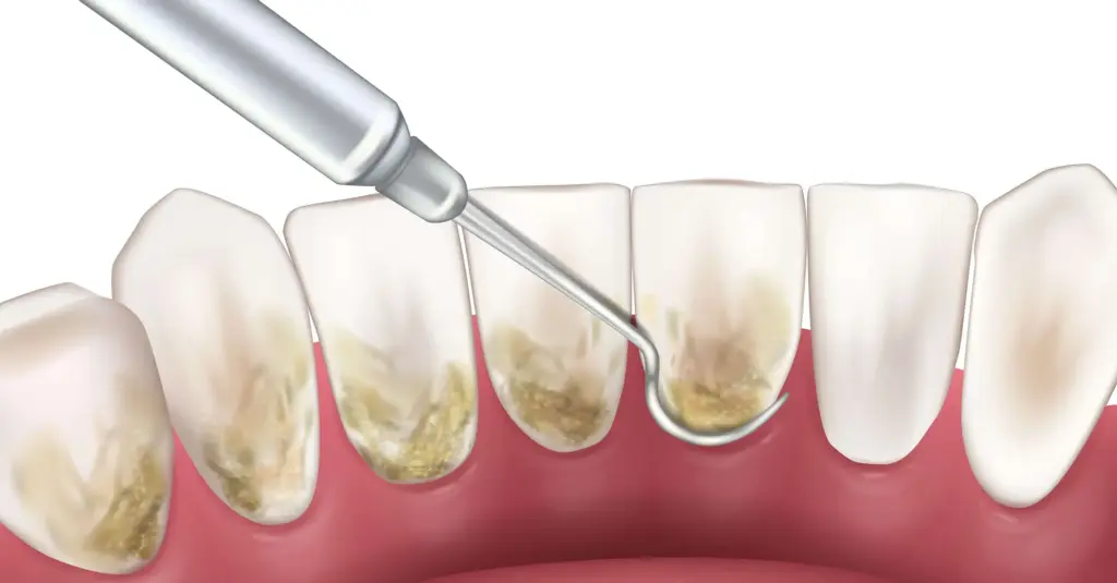 What Are Gum Diseases and How to Prevent It? A Practical Guide by WellDemir 2 what is gum disease