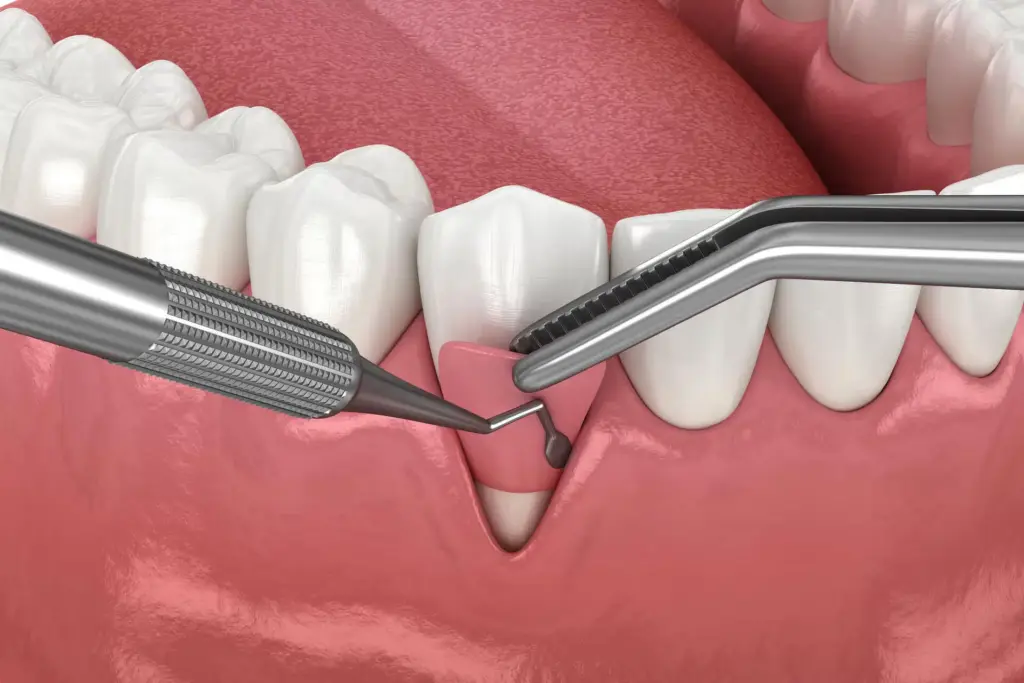 what is gum graft surgery