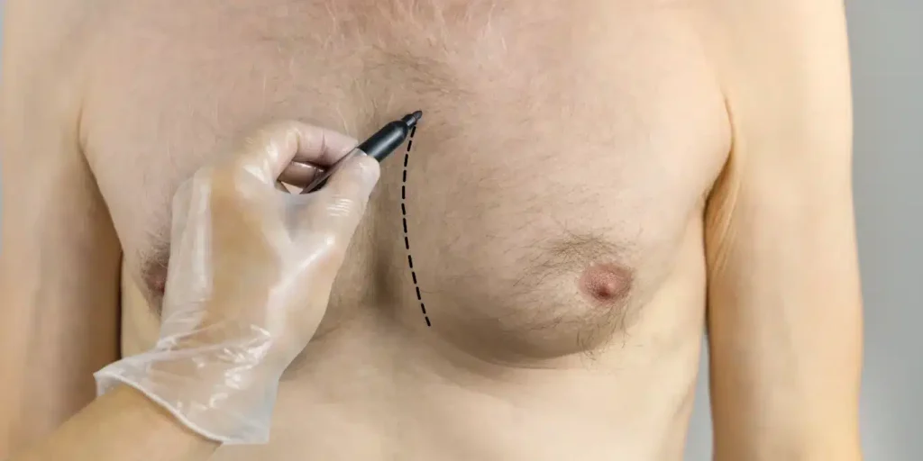 what is gynecomastia