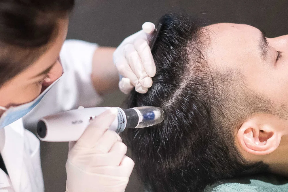 Hair Mesotherapy: Treatment, Products, Cost Factors & Results 2 what is hair mesotherapy