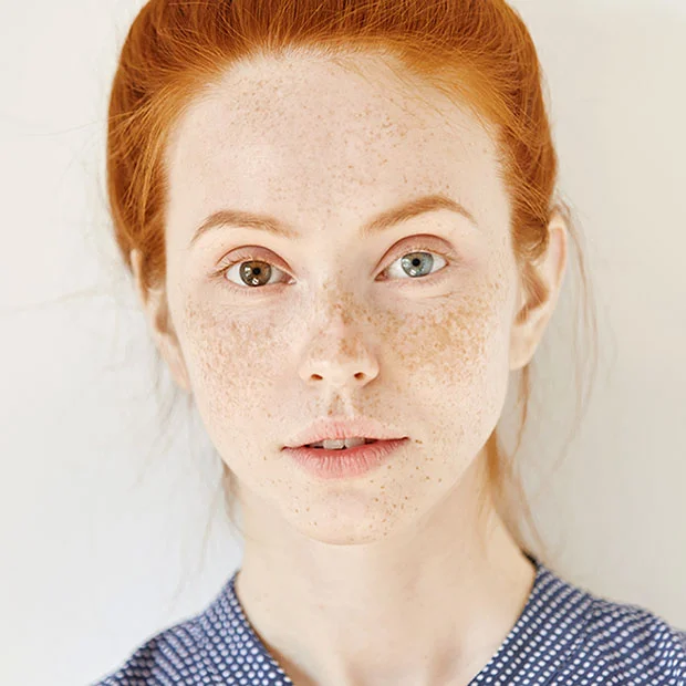 heterochromia