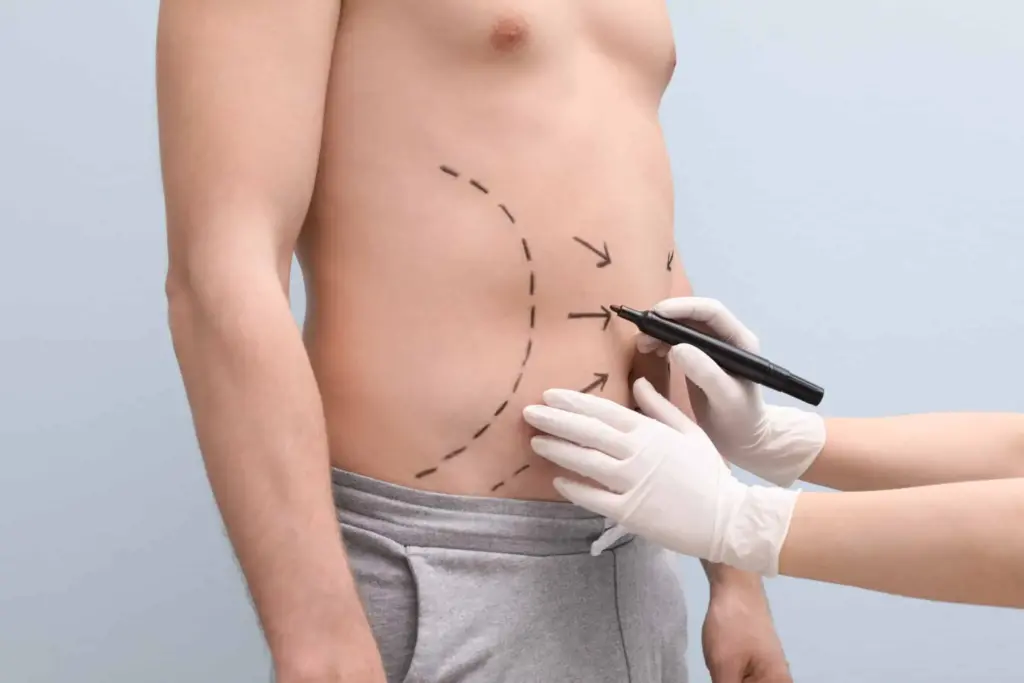 what is high definition liposuction