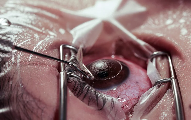 What Is ICL Surgery? Costs, Requirements & Recovery 2 what is icl surgery