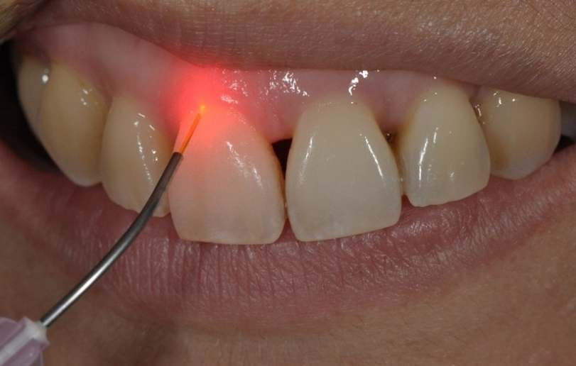 what is laser gingivectomy