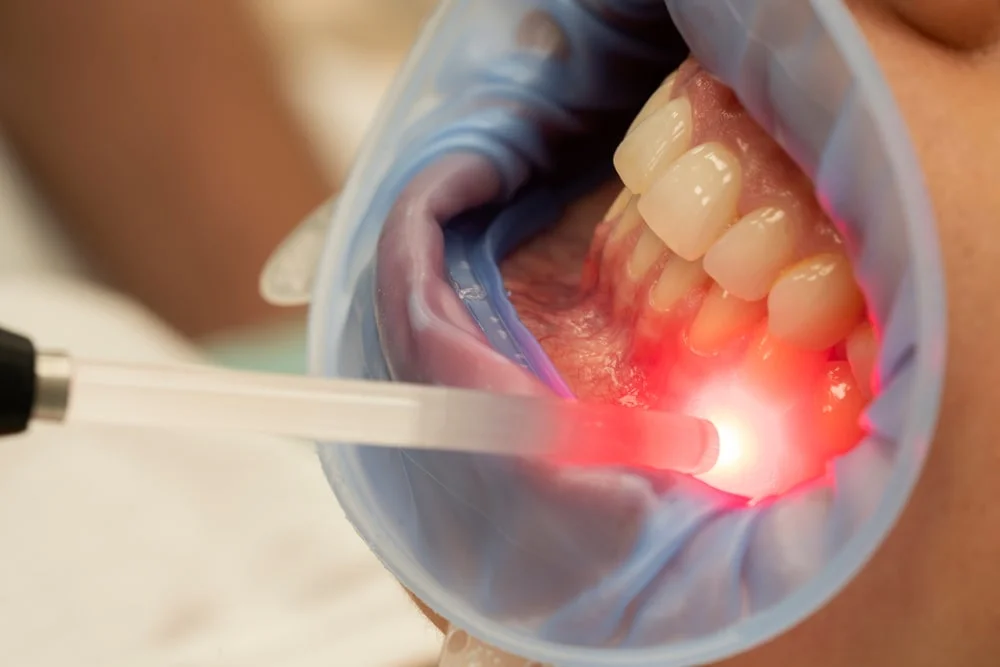 what is laser gum contouring