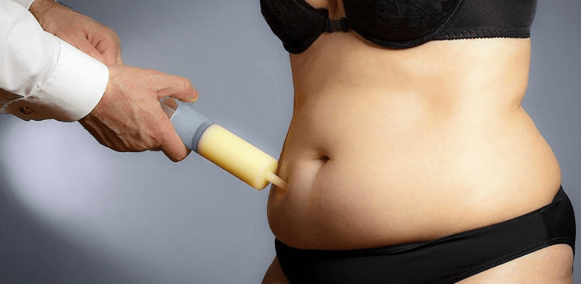 what is liposuction surgery