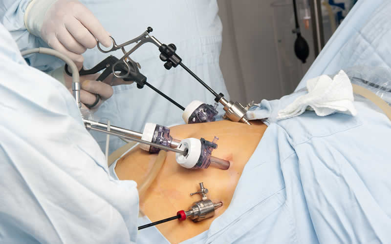 what is mini gastric bypass