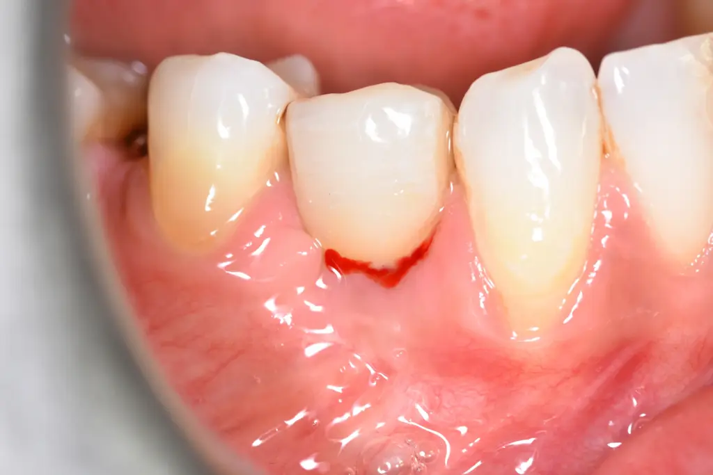 peri-implantitis