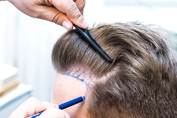 Haartransplantatie met 'Plugs': Herstel van Poppenhaar & Kosten 1 what is pluggy hair transplant