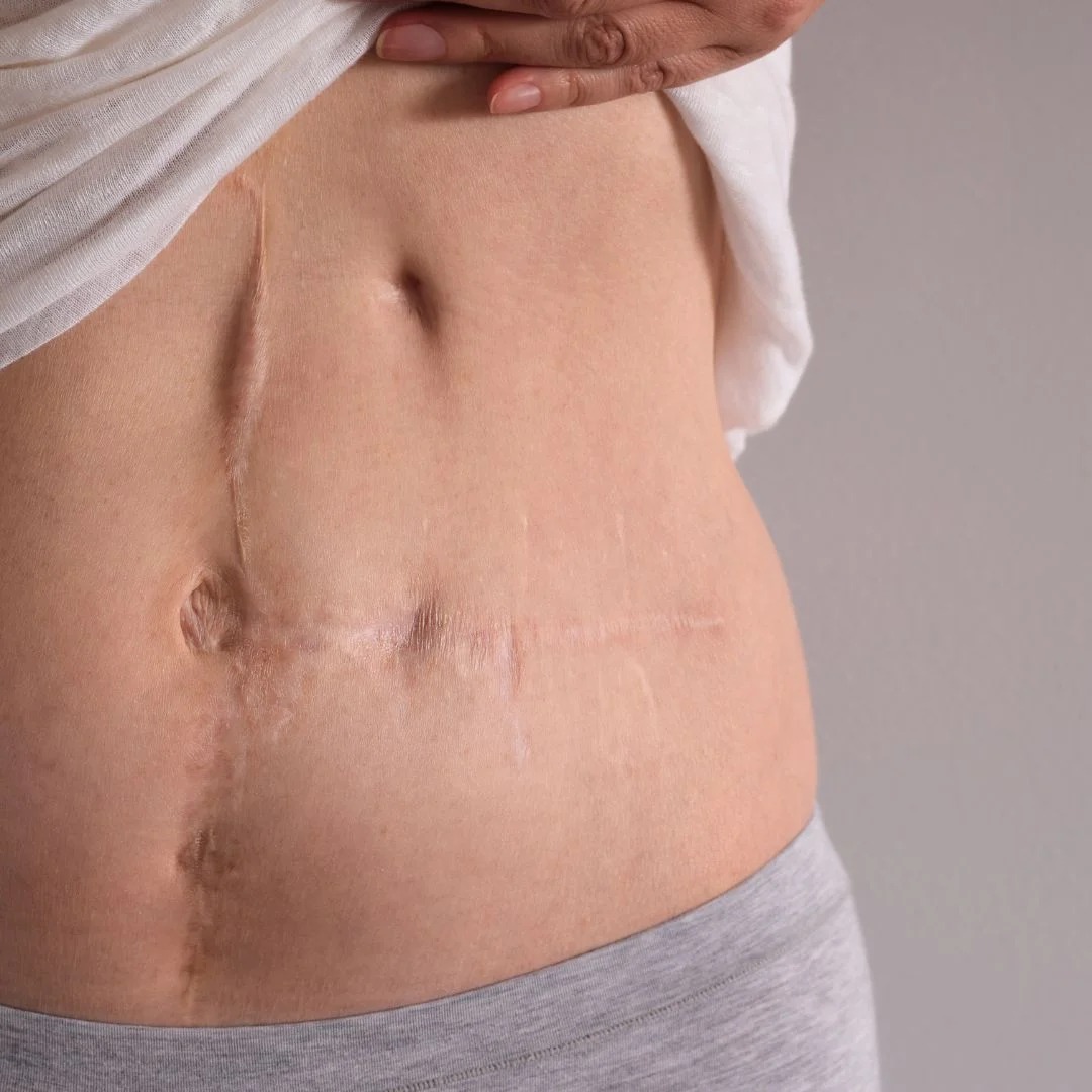Seroom na Liposuctie Oorzaken, Symptomen & Behandeling