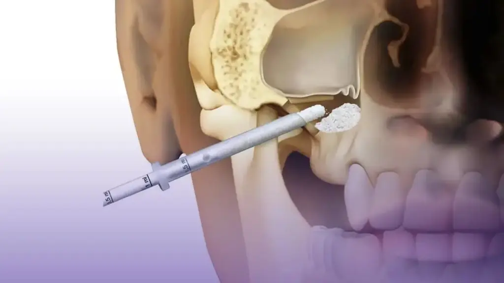 what is sinus lift