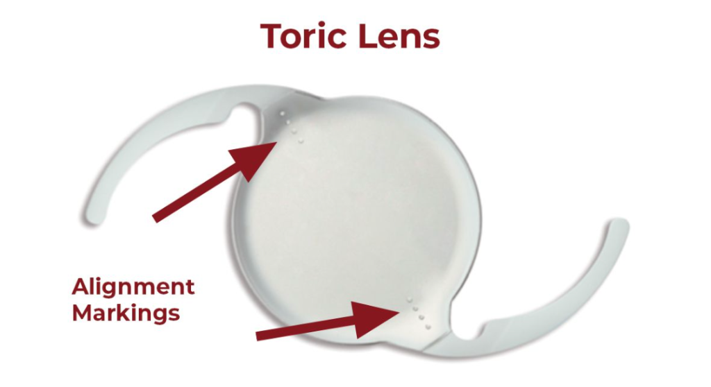 What Is a Toric Lens? What Is Its Purpose? 2 what is toric lens