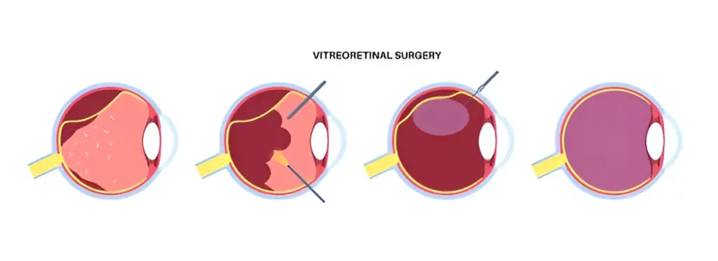 What is Vitrectomy? Surgery Steps, Recovery & Risks 2 what is vitrectomy surgery
