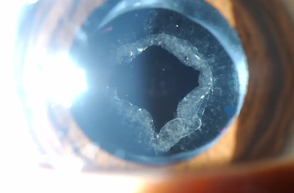 What Is YAG Laser Capsulotomy? In What Situations Is It Used? 3 yag laser capsulotomy