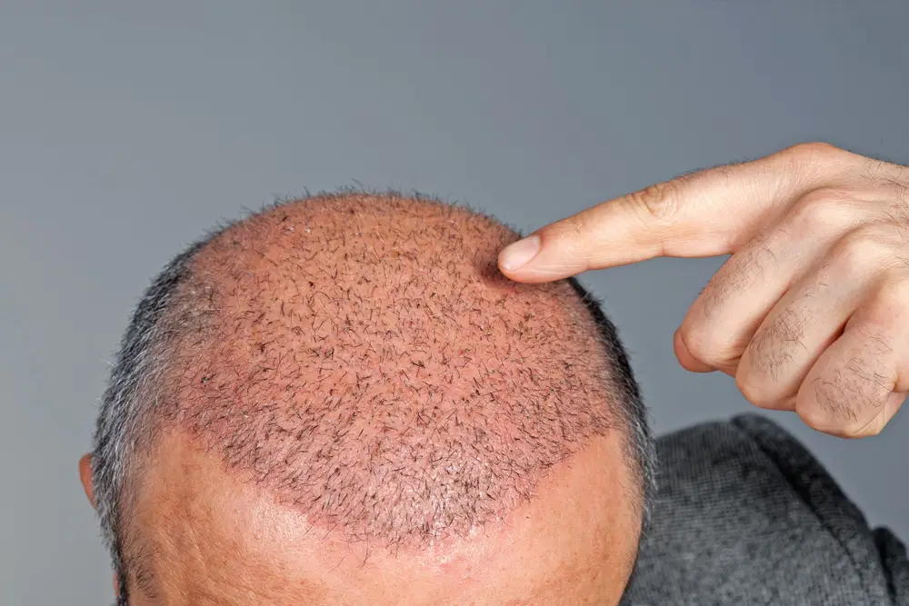 why choose turkey for hair transplant