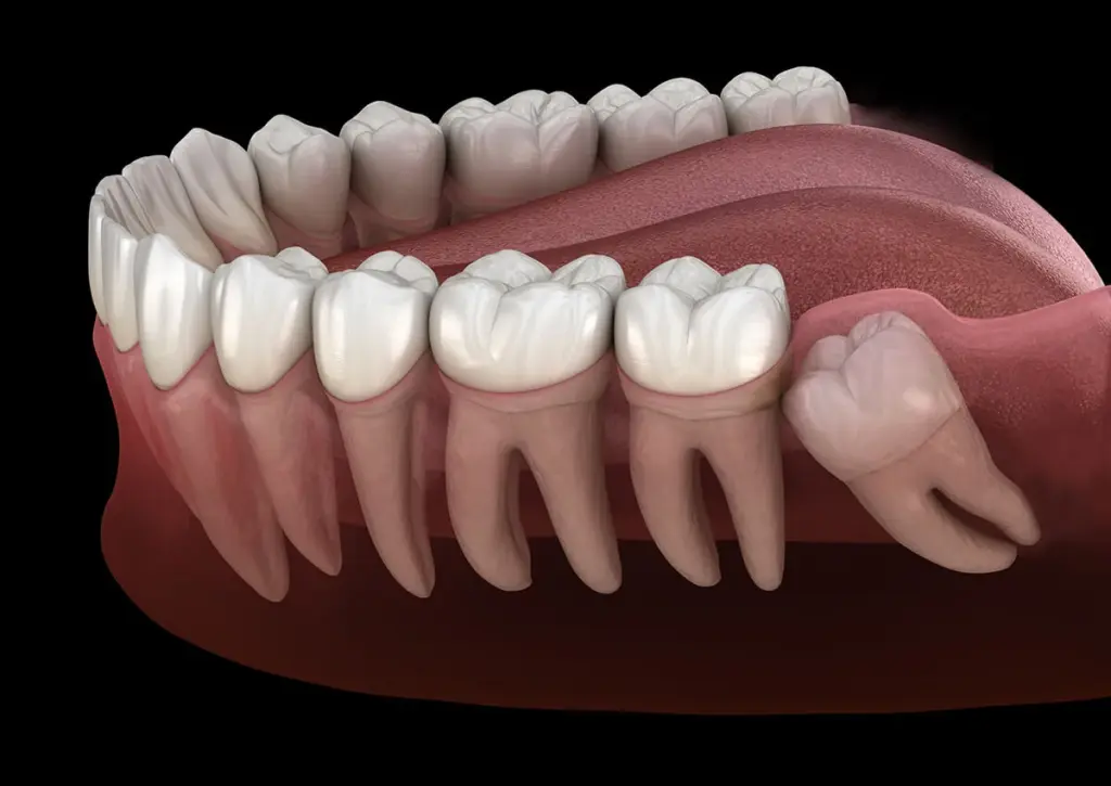 Wisdom Teeth Removal: Cost Factors, Recovery, Diet, Pain & Swelling 2 wisdom teeth removal