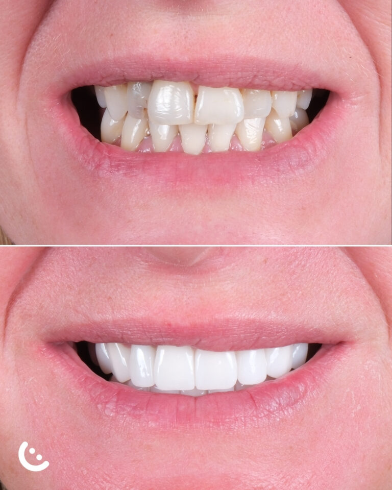 zirconia crown in turkey before after