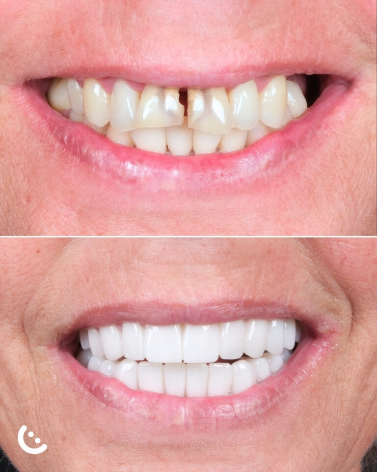 zirconium crown in turkey before after